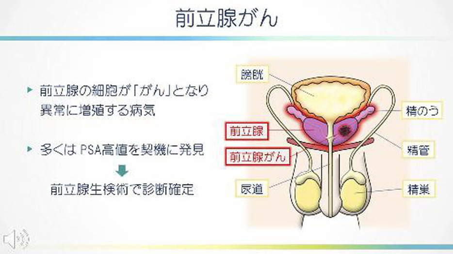 福島医大医学部泌尿器科学講座が作成したインフォームドコンセント用の動画。イラストが中心で、患者への分かりやすい情報提供に加え、医師の長時間労働といった課題解決を目指す