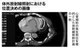 体外放射線照射における位置決めの画像