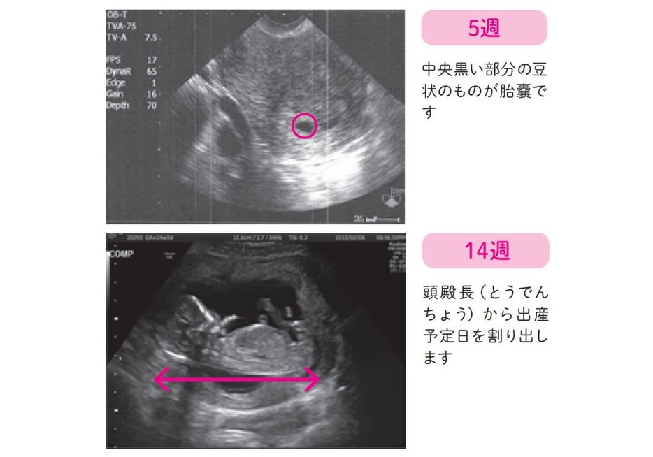 エコー写真