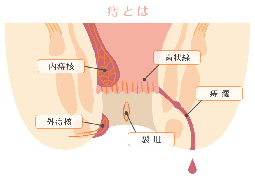 痔とは