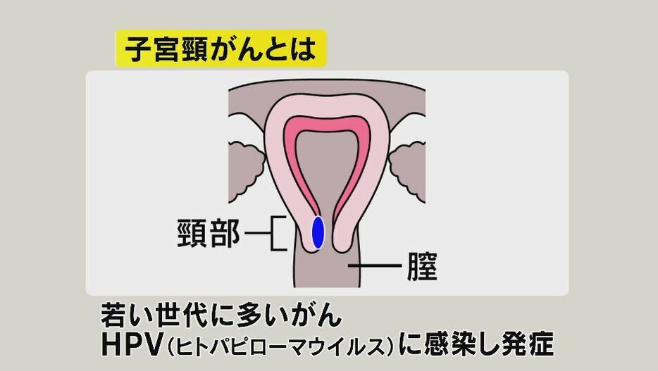 子宮頸がんとは