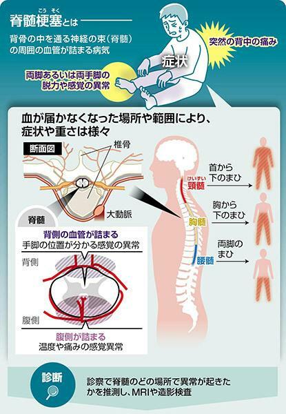 脊髄梗塞とは