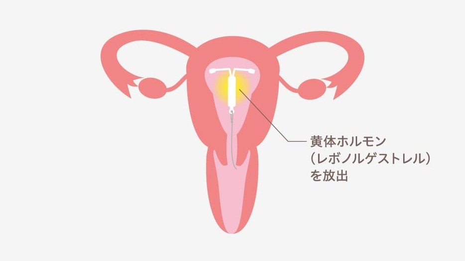 ミレーナからは黄体ホルモンと同じ作用をする「レボノルゲストレル」という成分が放出され、子宮内膜に作用することで、約5年間、避妊や生理通の症状緩和の効果が期待できる