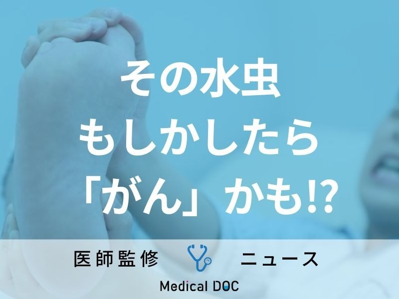 「水虫」はがんのサイン!? 皮膚がんの一種“メラノーマ”との関連性を報告 東京慈恵会医科大学