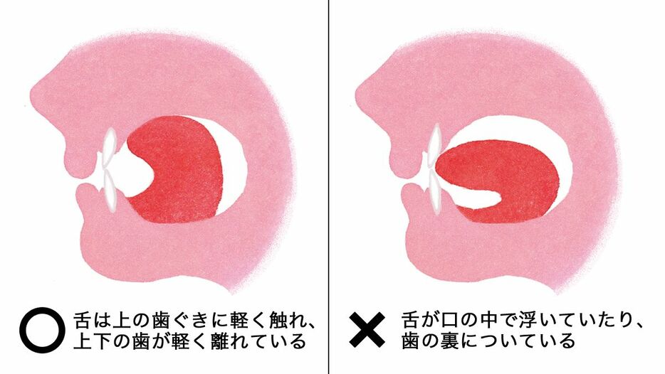 （左）〇舌は上の歯ぐきに軽く触れ、上下の歯が軽く離れている（右）×舌が口の中で浮いていたり、歯の裏についている