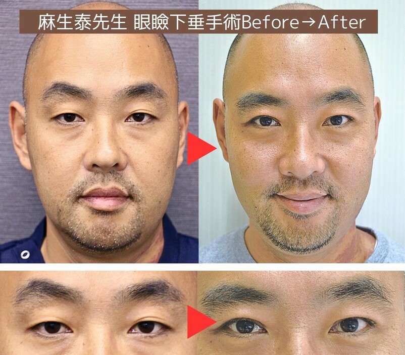 麻生先生の眼瞼下垂手術Before→After