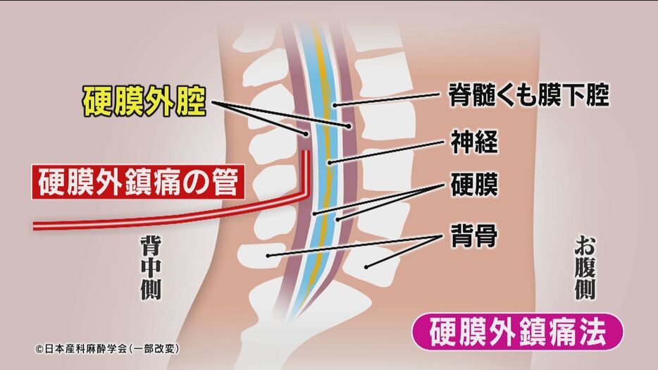 硬膜外鎮痛法