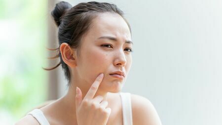 ニキビを治そうと思った女子大生を襲った悲劇とは……（写真：Taka／PIXTA）