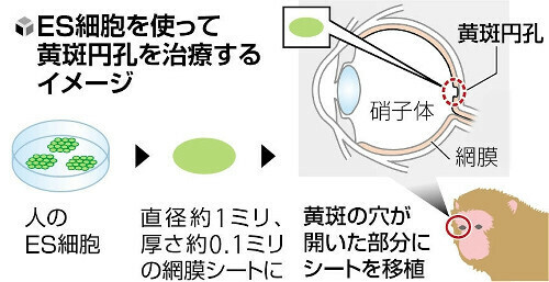 ＥＳ細胞を使って黄斑円孔を治療するイメージ