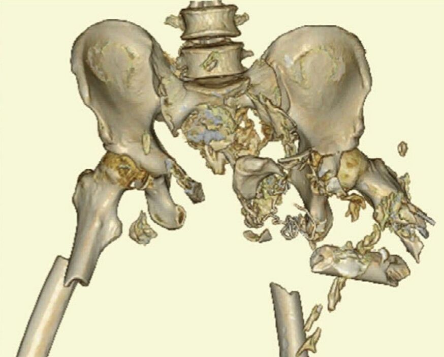 病院搬送後に下川さんの下半身を撮影したエックス線画像。骨盤が粉々になっている(大村医師、下川さん提供)