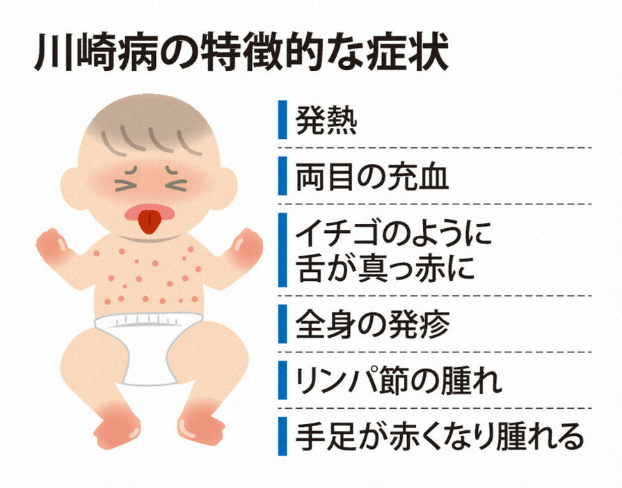 川崎病の特徴的な症状