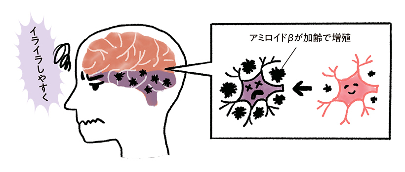 アミロイドβが脳に溜まりすぎて症状が出る場合は、感情や記憶をつかさどる部位から不調となって表れるため、イライラや物忘れをしやすくなります。