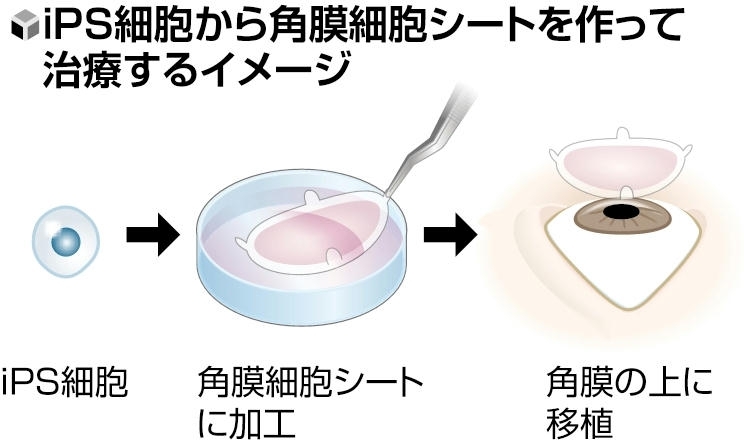 iPS細胞から角膜細胞シートを作って治療するイメージ