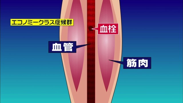 足の血行が悪くなると血栓ができる