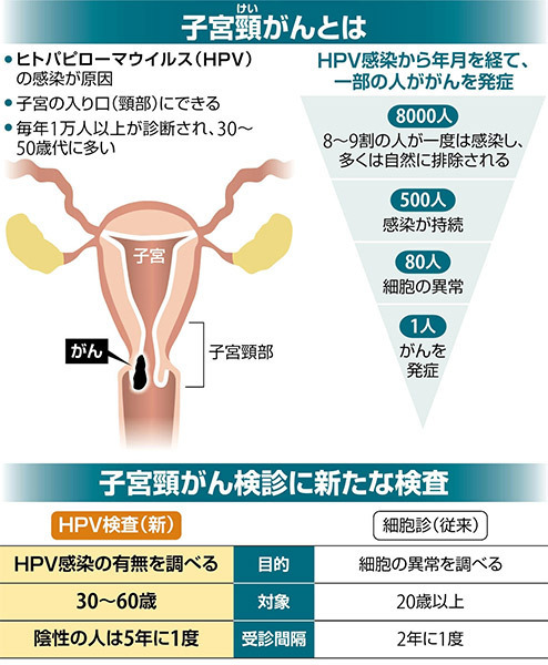 子宮頸がんとは