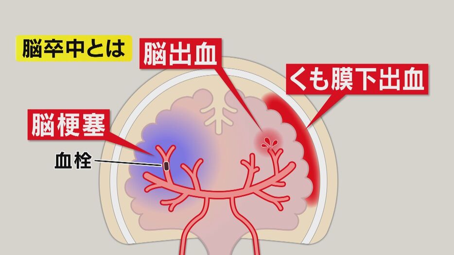 脳卒中とは