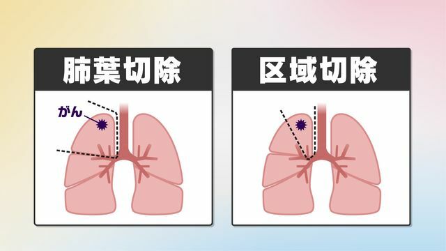 「肺葉切除」と「区域切除」