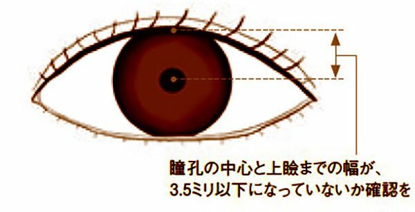 ●「眼瞼下垂」でチェックするポイント