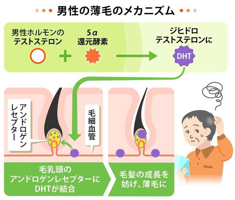 男性の薄毛のメカニズム