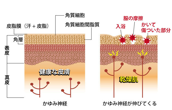 バリア機能が低下し乾燥した肌はかゆみを感じやすくなる