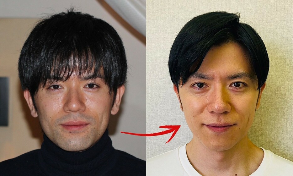 ▲ 脱毛ビフォー＆アフター。左の脱毛前（30歳）はヒゲを剃っても青ヒゲ状態。脱毛後の右（41歳の現在）はツルツルで肌のコンディションも良好