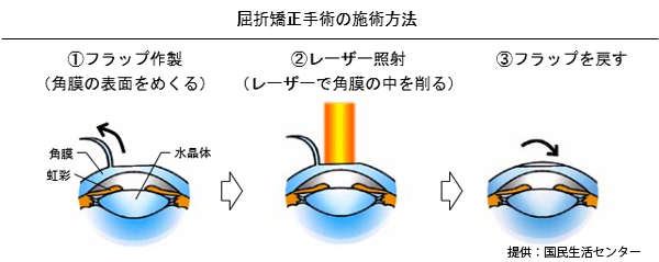 [図]屈折矯正手術の施術方法（提供：国民生活センター）