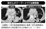 肺がんのテーラーメイド治療画像