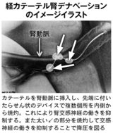 経カテーテル腎デナベーションのイメージ