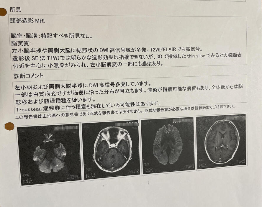 智史さん（仮名）は、がんの診断を受けた最初の病院で、脳梗塞の可能性を指摘されていた（本人提供）