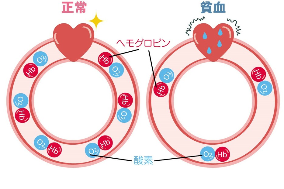 更年期と間違いやすい病気・貧血