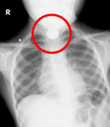 ボタン電池を誤飲した子どものX線検査画像（国民生活センターの発表資料より）