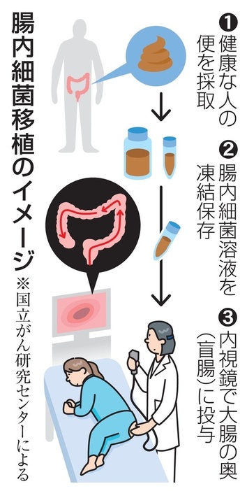 腸内細菌移植のイメージ