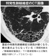 特発性肺線維症のCT画像