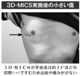3D-MICS実施後の小さい傷