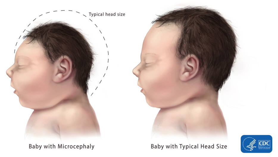 [画像]左：小頭症の赤ちゃんの頭のサイズ、右：平均的な頭のサイズ（c）CDC