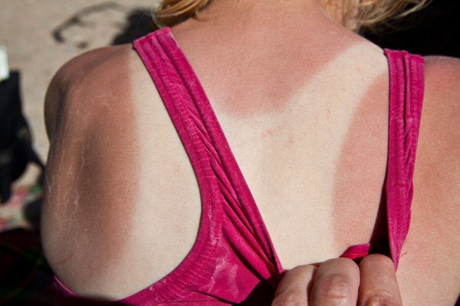 皮膚がんは首や腕など日光にさらされる部位にできるのが一般的だが、意外な場所にできることもある。（PHOTOGRAPH BY SALLY ANSCOMBE, GETTY IMAGES）