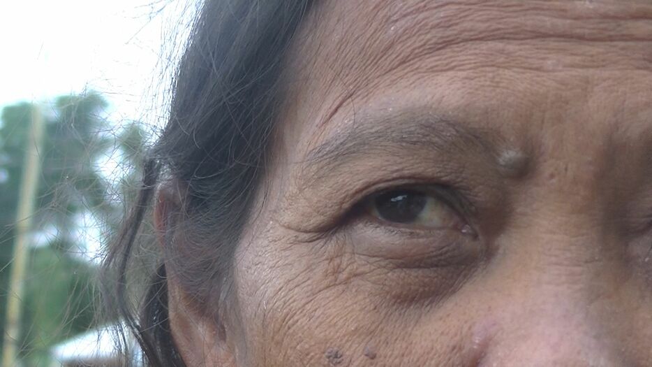 散布された農薬の影響か、右目を失明した住民（2017年12月撮影）（提供：PARC）
