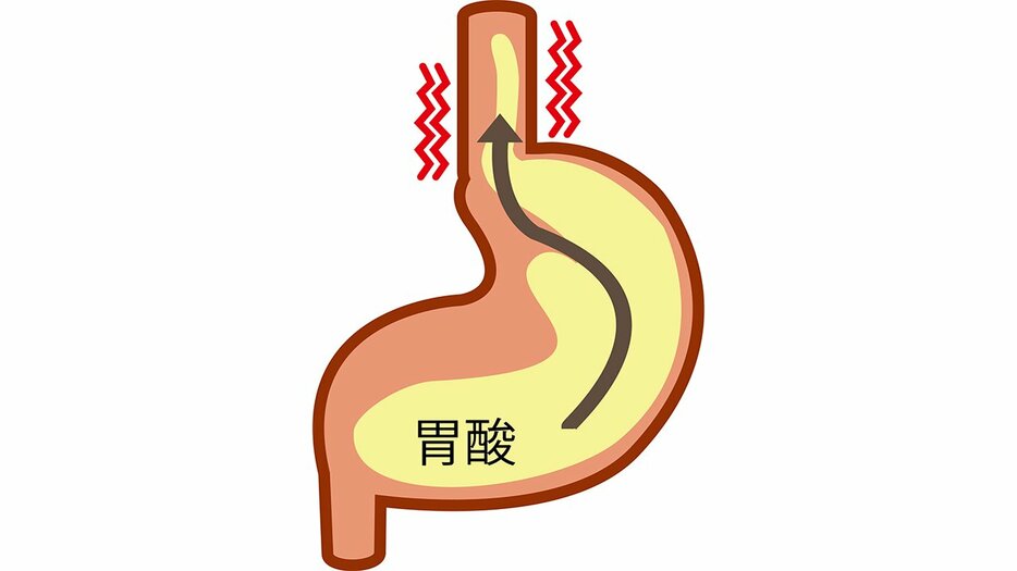 食堂がんのリスクを高める現代病