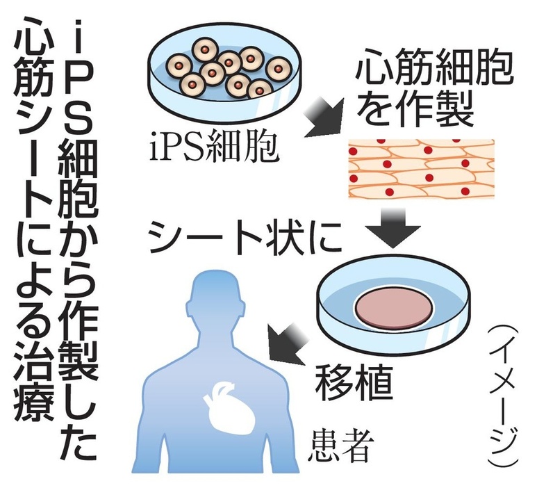 iPS細胞から作製した心筋シートによる治療（イメージ）