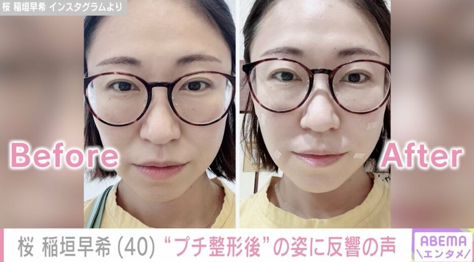 【写真・画像】エヴァ芸人・桜 稲垣早希(40) 移住先のタイで“プチ整形”を報告 施術後の姿に「可愛すぎて3度見した」　1枚目