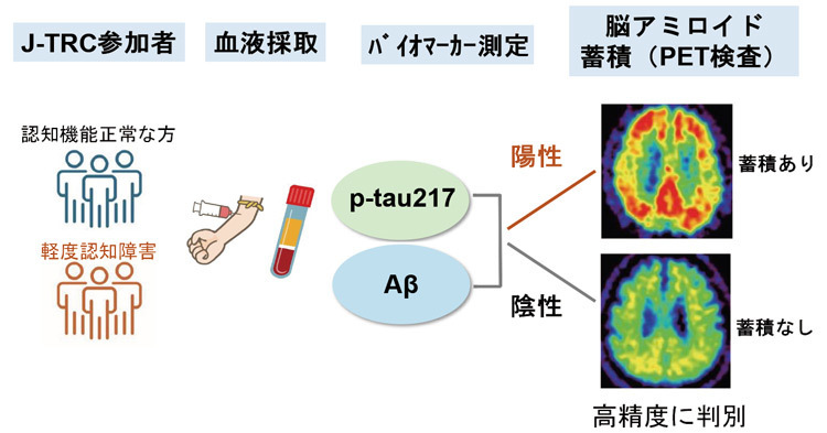 血液検査により原因物質の蓄積を判別する研究の概念図（研究グループの新潟大学・池内健教授作成、東京大学の岩坪威教授ら研究グループ提供）