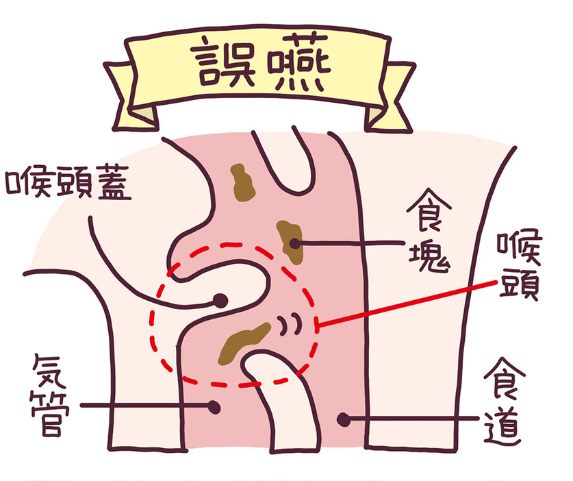 誤嚥。”喉の蓋”の開け閉めのタイミングがずれると誤嚥が起こりがちに