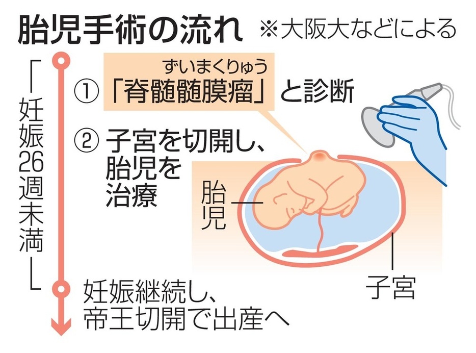 胎児手術の流れ