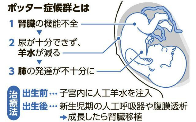 ポッター症候群とは