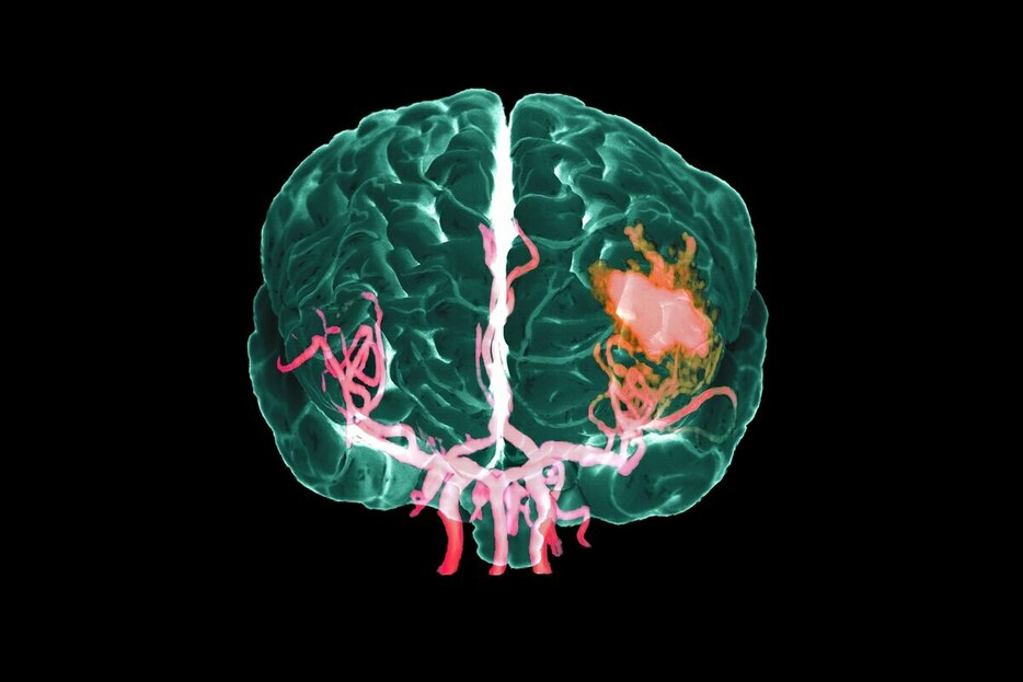 出血性脳卒中患者の脳内の出血（中央右の赤い部分）を示す、MRA（磁気共鳴血管撮影法）による彩色3D画像。動脈はピンク色で示されている。（Image by Zephyr/Science Photo Library）