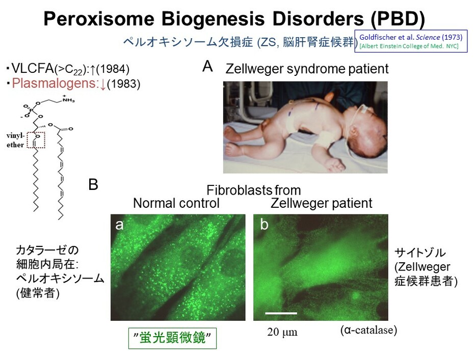 図のAの写真がペルオキシソーム欠損症の乳児。図のBは本症患者由来の皮膚細胞をカタラーゼ抗体（α-catalase）を用いて染色した顕微鏡写真像。健常者の細胞では顆粒状に染色されたペルオキシソームが無数に観える（a）が、患者細胞では認められない（b）（メカニズムなどについては後ほど解説します）（出典：藤木氏提供）