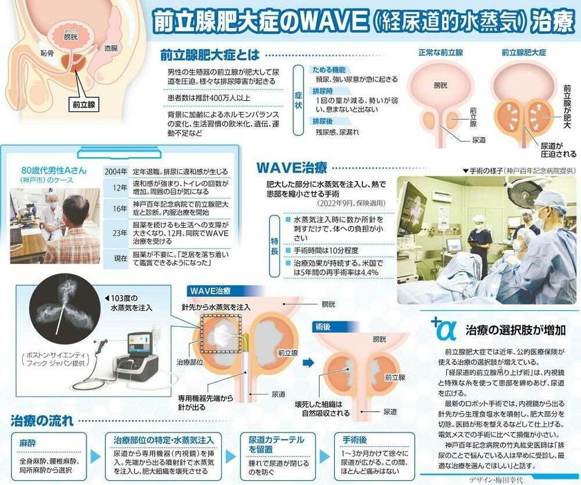 前立腺肥大症のWAVE治療