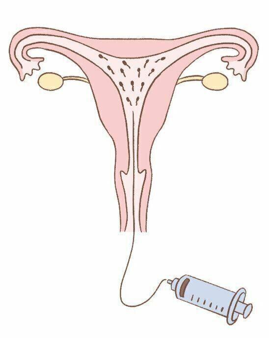 【人工授精】精子を子宮に注入して受精の確率を高める方法