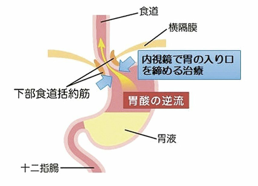 逆流性食道炎と治療のイメージ