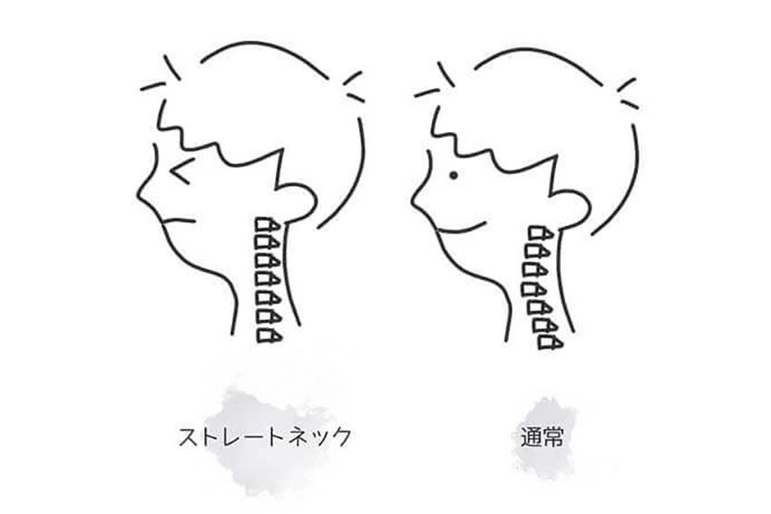 左がストレートネックの状態になっている。